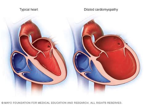 mildly dilated left ventricle.